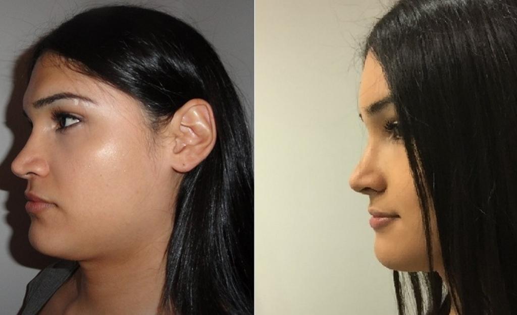 How is neck plastic surgery done right, facial liposuction cheeks ...