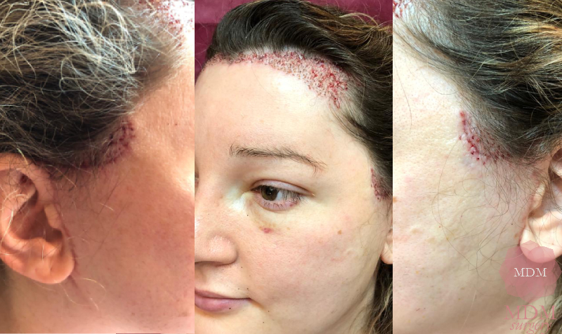 Mdm Surgery Hairline Transplant Hairline Correction In Ffrs