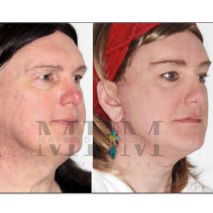 Facial Features Remodeling
