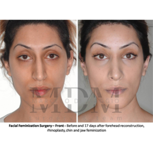 Facial Features Remodeling