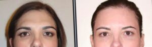 Eyes expression-Forehead-Feminization-Mexico1 - Copy
