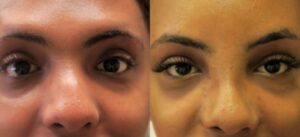 Eyes expression-Forehead-Feminization-nose-Mt Sinai1
