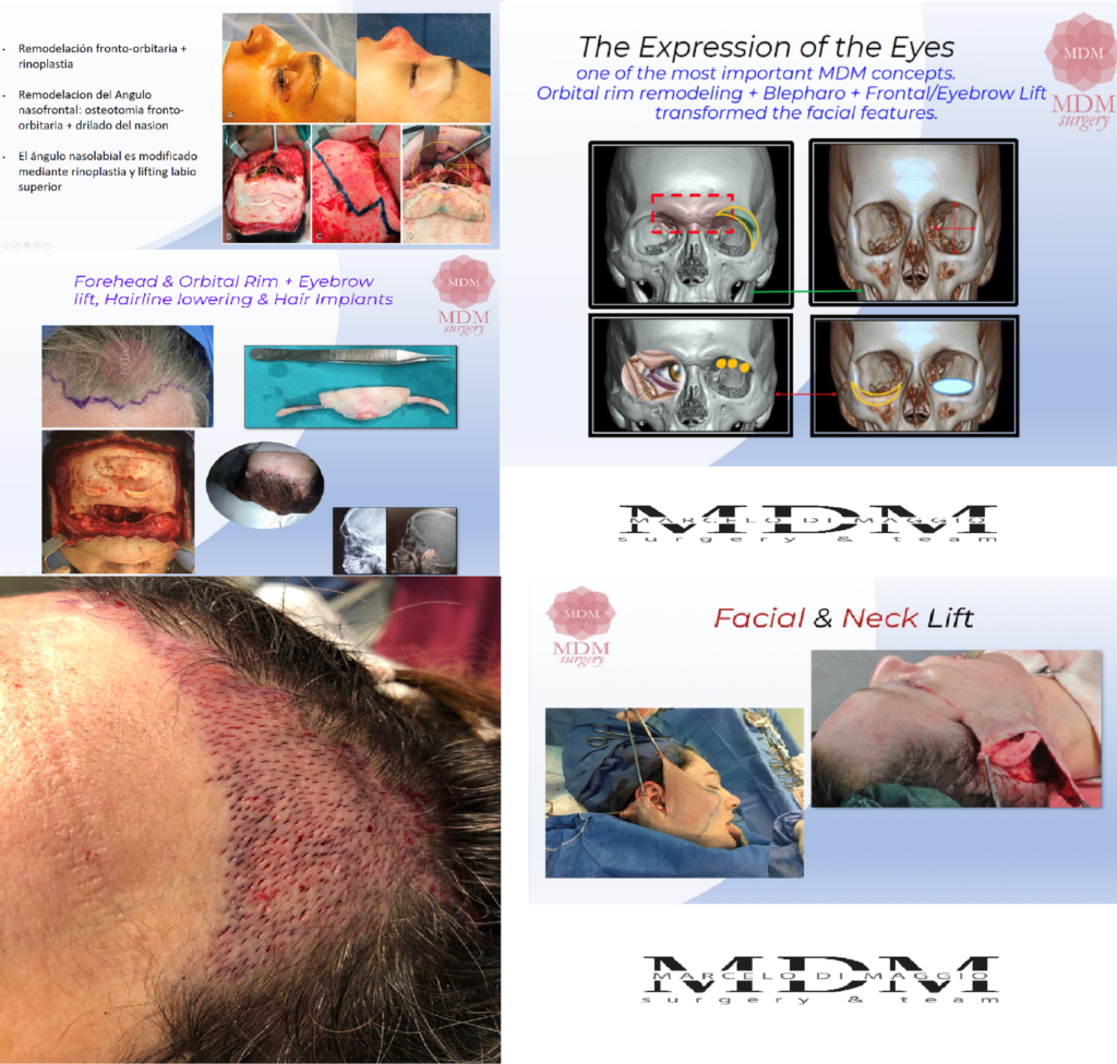 Forehead & Orbital Rim Remodeling - Rhinoplasty