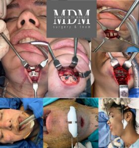 Jaw-Chin-osteotomy-remodeling