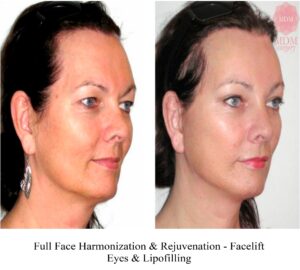 Rejuvenation-Feminization-FFS-Harmonization-Facelift